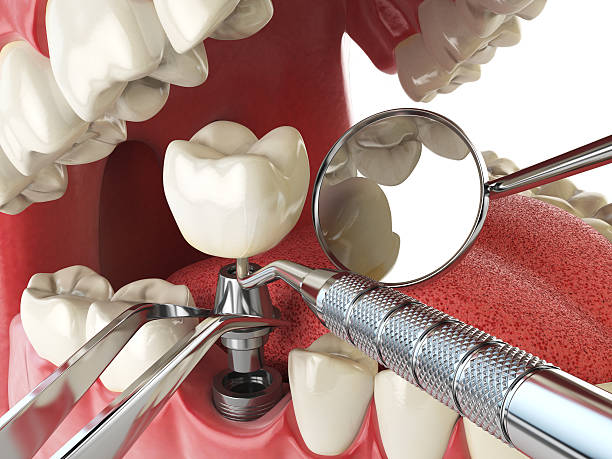 Best Emergency Dentist for Lost Fillings or Crowns in Lafayette, CA